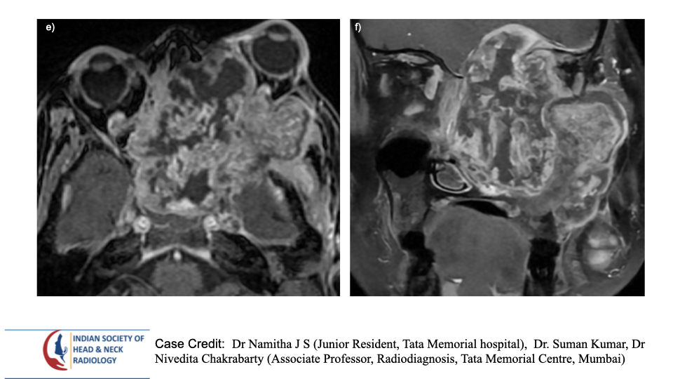 teamishnr's tweet photo. #caseoftheweekanswer

Please find the answer
#radiology #caseoftheweek #headandneck #radiologycases #dailywork #ISHNR #teaching #research #imaging #FOAM #FOAMRad #FOAMMed

Visit our website: https://t.co/4xzgh1IykC
All Cases: https://t.co/0xaPvoBy5H https://t.co/lmFboD8GbG