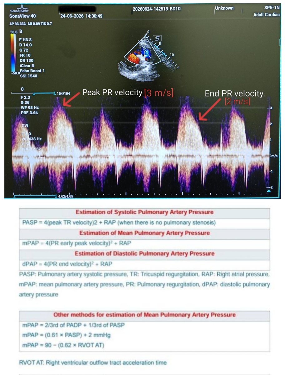 Shamsul_Hi's tweet photo. Using PR jet velocity for estimating mean Pulmonary artery pressure (meanPAP).
Here RAP = 15 .
mPAP= 4(3)² + 15 = 51 mmHg.
Can be used for estimating mPAP when TR velocity is less.
Here PR is Severe - Dense jet,steep deceleration &amp; early termination of diastolic flow.
#echofirst https://t.co/3Hg16Yt5HA