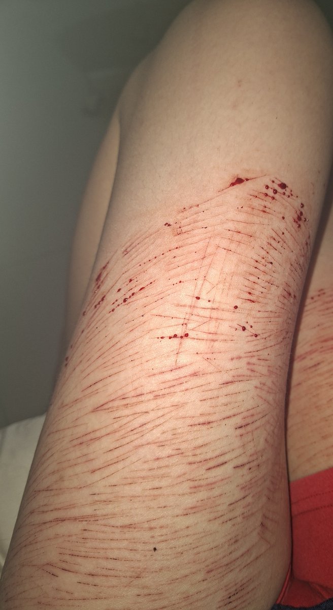 010Snsn's tweet photo. Ewww cat scratches☹️ https://t.co/FJQYb9TbS8