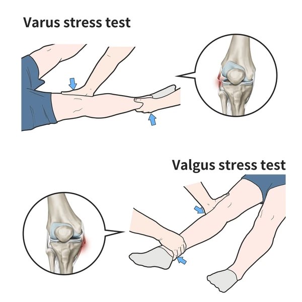 PTNouff's tweet photo. 🟣 رابعًا و اخيرًا : Collateral Ligaments

📍MCL
Blow to the lateral side
Valgus stress ➜ Think about MCL injury 

📍LCL
Blow to the medial side 
Varus stress ➜ Thinj about LCL injury https://t.co/Yhaomq7XDb