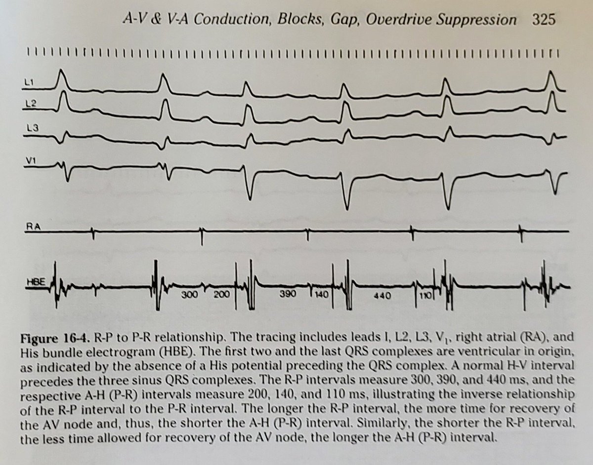 KostekMilan's tweet photo. 🟡 RP-PR reciprocity 🟡
"The R-P intervals measure 300, 390, and 440 ms, and the respective A-H (P-R) intervals measure 200, 140, and 110 ms...
 The longer the R-P interval, the more time for recovery of the AV node and, thus, the shorter the A-H (P-R) interval." https://t.co/4TG8vtwUuV
