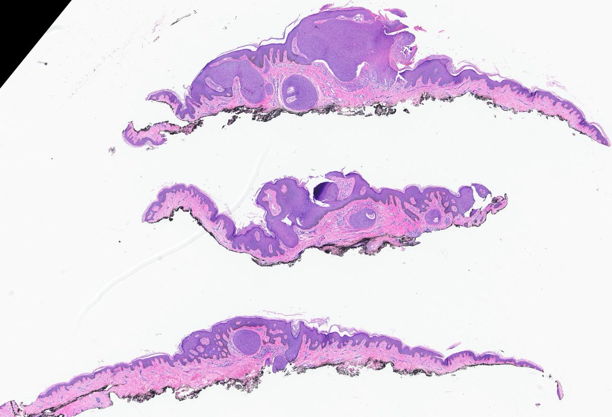 HENRYY_MD's tweet photo. @Pathology36 @DrGeeONE @Histopatolomon @glucerorg @pathologysocial I am doing fine, just a busy bee in a field of all kinds florishing pathology flowers, picking the nectar from them. Good to hear you are doing great.  Applying fellowship?  in what field?   I use this beautiful Poroma to welcome you back #dermpath🥰 https://t.co/YWDwKE7dBf