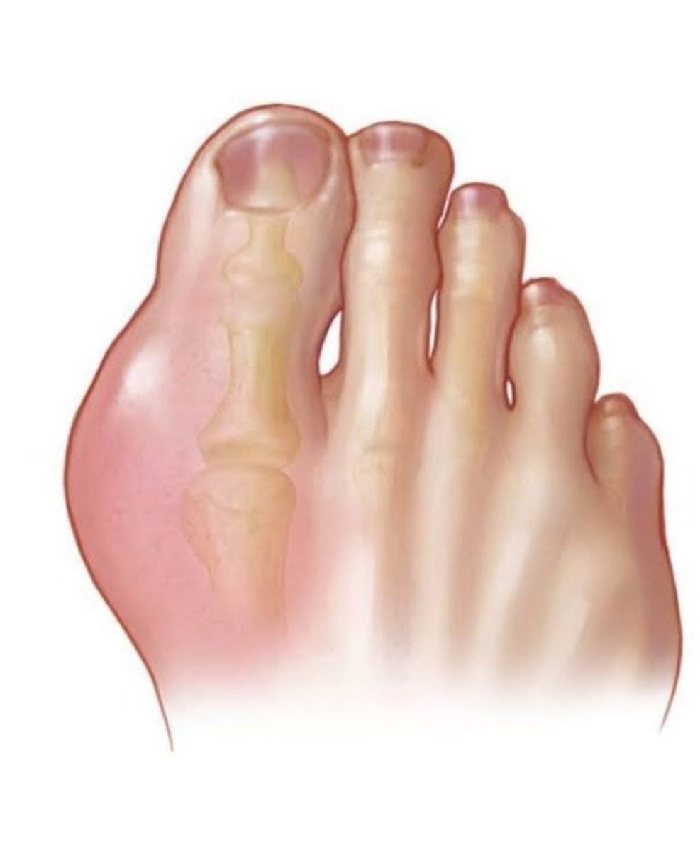 HAH2030_a's tweet photo. Gout is caused by the accumulation of ? https://t.co/WW2K5EDqt4