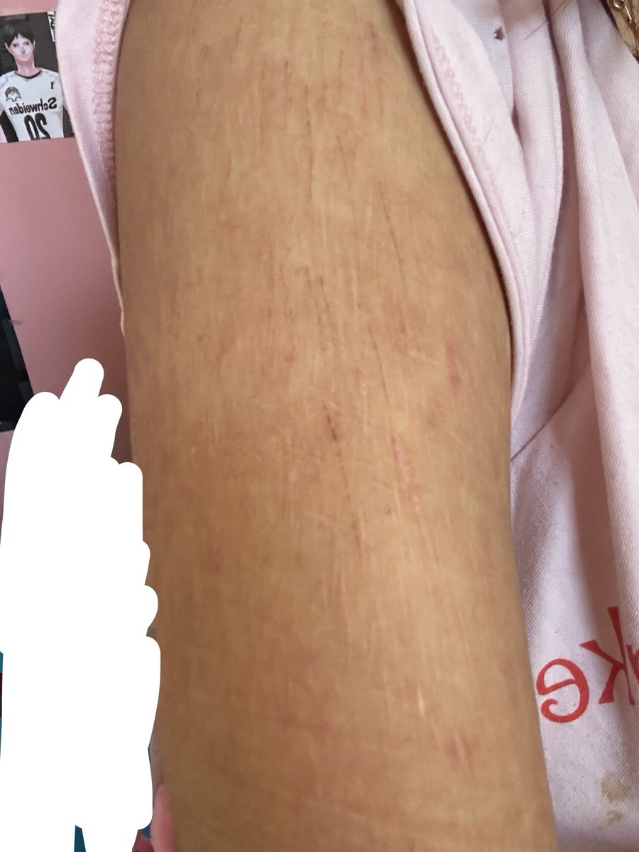 lev1fan's tweet photo. All of my scars so far (all of my cut are healed now) https://t.co/KudBdqLaof