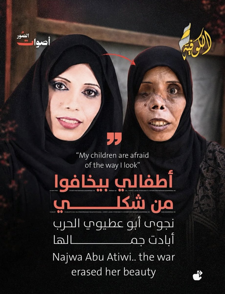 BusaidiNaser's tweet photo. هذا ما فعله اليهودي الإرهابي الإسرائيلي بأغلب نساء #غزة !
لم يشهد التاريخ الحديث كله أقسى من بشاعة الإبادة التي يرتكبها الجيش الإسرائيلي تجاه نساء وأطفال غزة حتى الآن!
لقد قتلوا خلال ألف يوم عشرات الآلاف من النساء وعشرات الآلاف من الأطفال .. ليصل إجمالي الشهداء قرابة 100 ألف ضحية!
وإصابة نصف مليون جريح!
بالإضافة إلى عشرات الآلاف من الأسرى الذين يتم تعذيبهم واغتصابهم وقتلهم بشكل ممنهج!!
