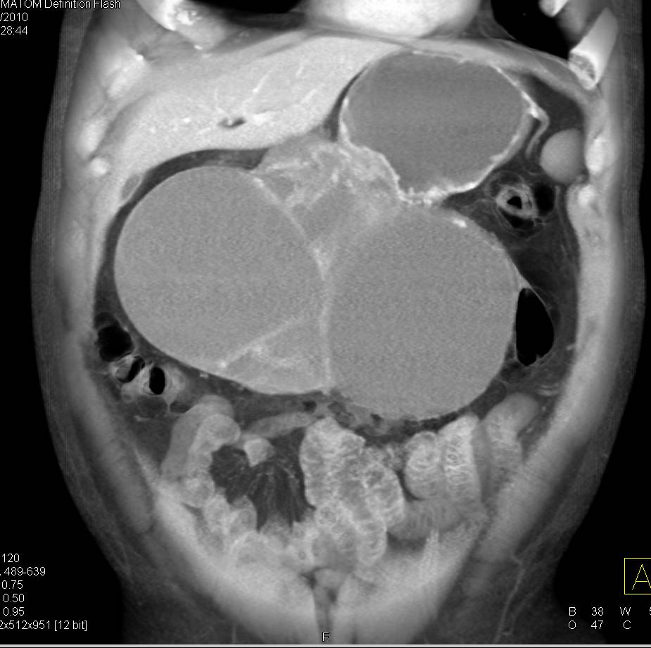 ctisus's tweet photo. Case 7: what is the dx?

Find the answer here: https://t.co/gQZ5RVRE4K https://t.co/WeMbXkovEn