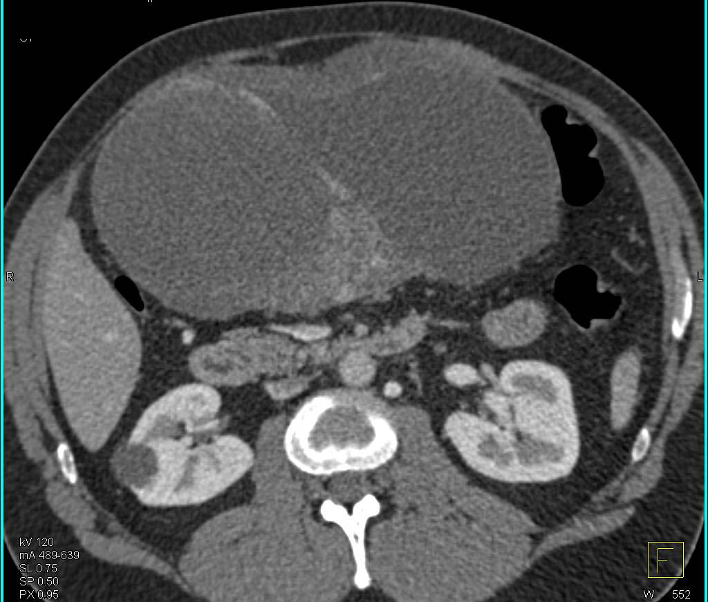 ctisus's tweet photo. Case 7: what is the dx?

Find the answer here: https://t.co/gQZ5RVRE4K https://t.co/WeMbXkovEn