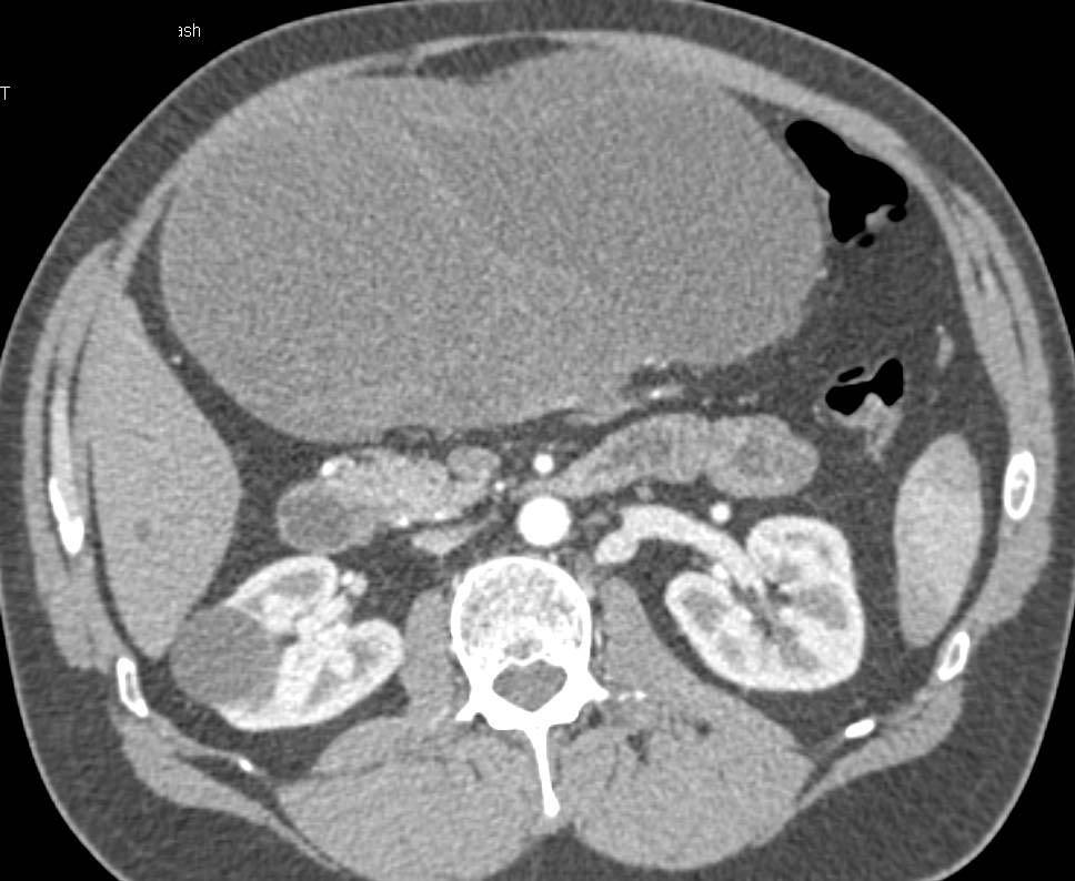 ctisus's tweet photo. Case 7: what is the dx?

Find the answer here: https://t.co/gQZ5RVRE4K https://t.co/WeMbXkovEn