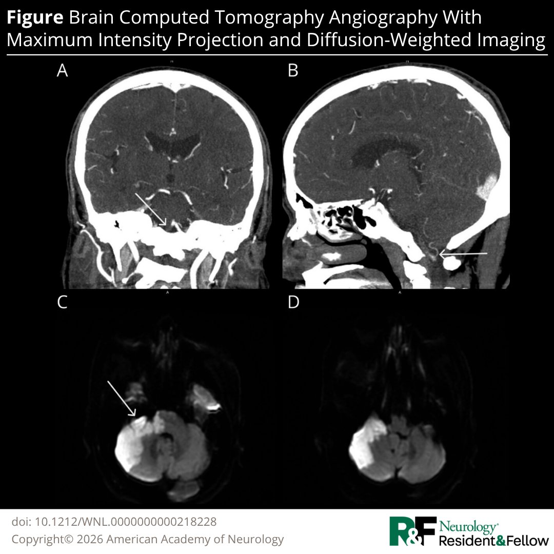 GreenJournal's tweet photo. Teaching Video NeuroImage: Vertebral Artery Occlusion Presenting With Peripheral Facial Palsy and Bruns Nystagmus https://t.co/toYosHPUtA 

#NeurologyRF https://t.co/O26dx3YLbI