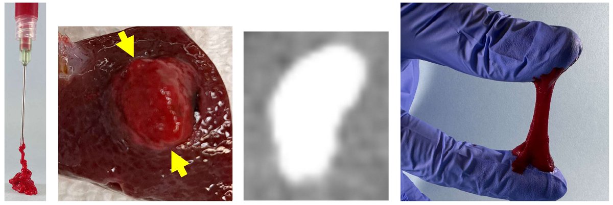 EdBoas's tweet photo. Just published! New intratumoral depot immunotherapy platform achieves 6 days of intratumoral drug release, from a single injection. Tumors can be “painted” with drug percutaneously, and the drug stays exactly where it’s injected, maximizing immune activation in the tumor, while reducing systemic toxicity. Highly toxic drugs can be injected into tumors, with no serious or severe adverse events.
https://t.co/ANZ3SMWoRe