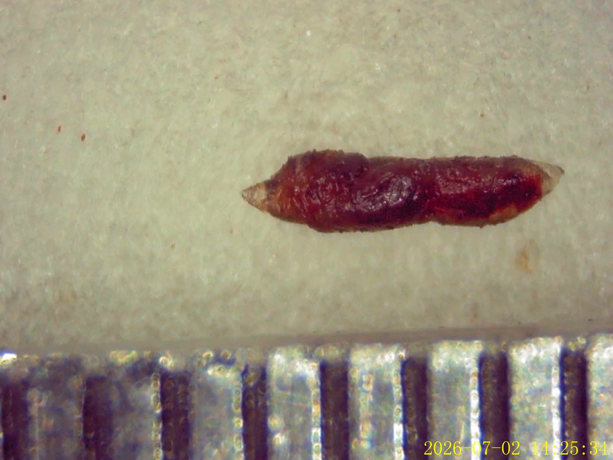 davidiorlano's tweet photo. @dgbrackett Interesting. Theyt remind me of these that I found in my skin... which are only 2 mm... Do you know what they might be?? https://t.co/nliRrXpDvU