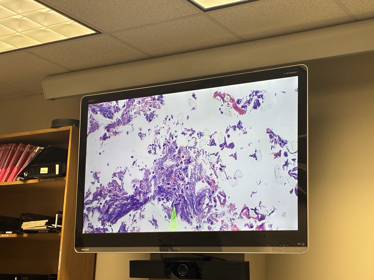 ccf_idfellows's tweet photo. We brought our new fellows to Endocarditis valve rounds today! #IDTwitter #CCFID https://t.co/wuDoSDynRI