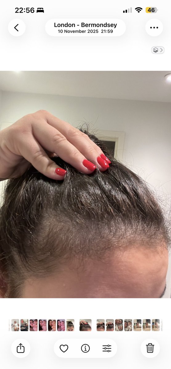 Oji_yellow's tweet photo. Se acuerdan que les conté hace como 6 meses que me estaba quedando calva? encontré mi salvación. 

La primera foto nov/25 a las otras 2 son a hoy. 

En el primer comentario se los dejo porque no me alcanzan las fotos https://t.co/MI4VspQEnb