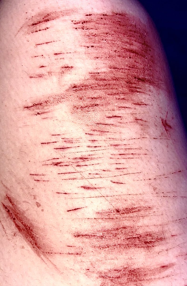 mxonzen's tweet photo. small cutting session //  cutting on call with people and showing them it makes it more interesting, idk why but yea

#shtwt #selfharm https://t.co/X82bWrDaSy
