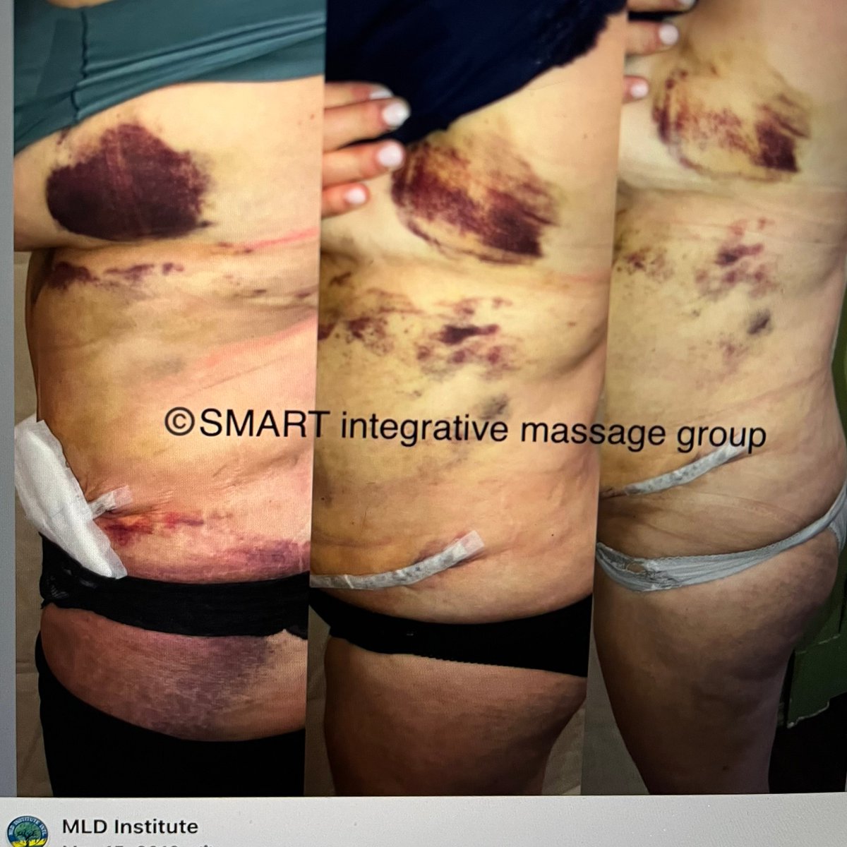 MLDInstitute's tweet photo. New Jersey Master Therapist demonstrates MLD several days in a row after learning at the MLD Institute International. She's a pro today. Great job Darcy! First Lady of Lymph. https://t.co/f833HdBqbj