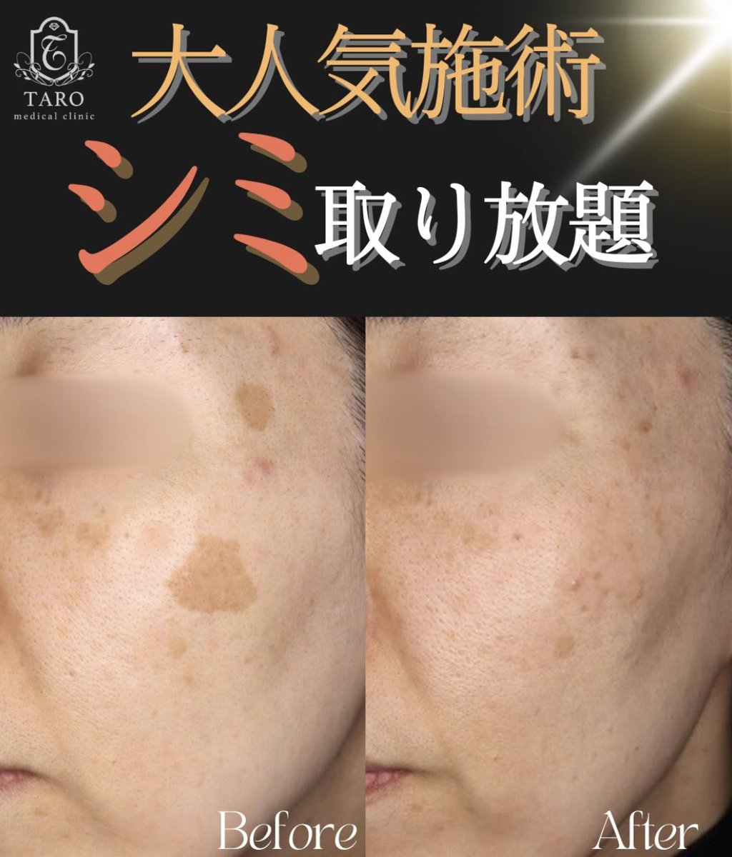 taroclinic's tweet photo. たろうメディカルの大人気施術✨
シミ取り放題の症例です😇🤍
更に内服や外用を併用して頂くことで更に効果が期待できます😳
お気軽にお問い合わせ下さい🙌

#シミ #シミ取り放題 #ピコレーザー #美肌
#肌治療 #美容医療 #美容クリニック #たろうメディカルクリニック https://t.co/RnuADj9UlP