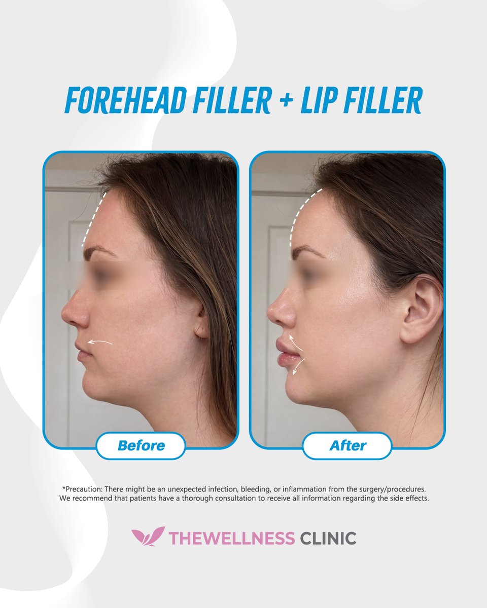 thewellnessen's tweet photo. Elegant Forehead Curves &amp; Plush Lips ✨

Soften your entire expression! See how pairing forehead filler to turn flat planes into an elegant, gentle curve with premium lip filler to add vertical volume creates a beautifully balanced, perfectly proportioned side profile! 👇 https://t.co/7wbxlB9TNV
