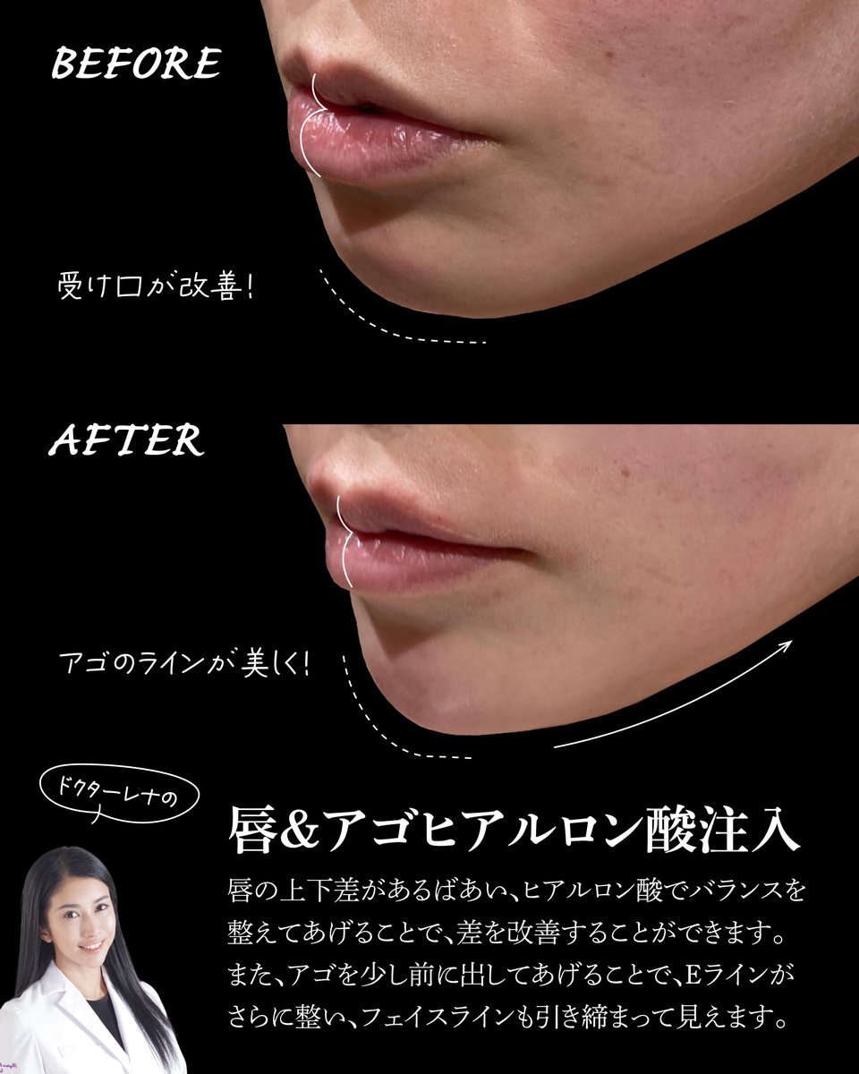 Rejuva3's tweet photo. ヒアルロン酸で「受け口」改善

上下の唇のバランスを整えてあげることで、受け口な見た目を改善することができます
アゴのヒアルロン酸を併用することで、横顔のバランスがより美しくなります☺

ご予約はこちらから
LINE@rejuva
https://t.co/CAmIyUYc8G
#Eライン #ヒアルロン酸 https://t.co/RdYNQAcuLX