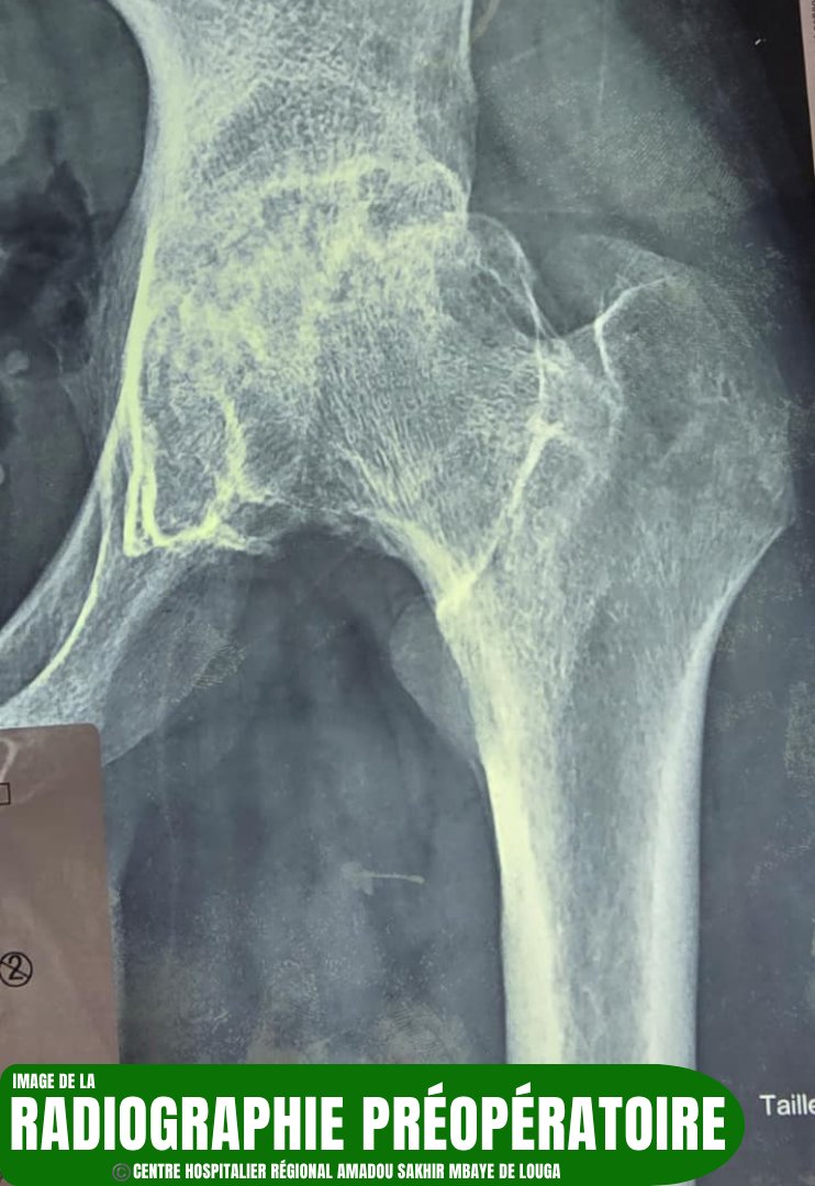 chrasml's tweet photo. DÉMARRAGE DES ACTIVITÉS DE PROTHÈSE TOTALE DE HANCHE AU CHRASML

Pathologies prises en charge :
- Coxarthrose (arthrose de la hanche) 
- Ostéonécrose de la tête fémorale https://t.co/tMxPvpkPbs