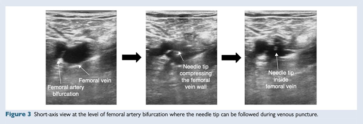 EHRAPresident's tweet photo. 🫀 #EHRAtopicweek | Vascular access in EP

How common are vascular complications in everyday EP practice?

Ultrasound-guided vascular access significantly reduces the overall vascular complication rate (1.2% vs. 3.2%) compared with the conventional approach (meta-analysis including 1 RCT and 1 observational study).

✅ Shorter puncture time
✅ Higher first-pass success
✅ Fewer puncture attempts
✅ Fewer inadvertent arterial punctures
✅ Benefits both trainees and experienced operators

Ultrasound-guided vascular access should become standard practice in every EP lab.

Read more 👉 https://t.co/Jw1CHjUzaD
@escardio #EHRA_ESC