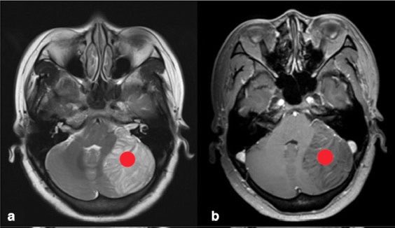 DrAyubaD's tweet photo. EASY ONE 🔥🔥

Young adult with headache, ataxia and signs of raised ICP.

Spot the abnormality? 👇

#MedX #Radiology #FOAMrad #NeuroRad https://t.co/xMuf4EuSpQ