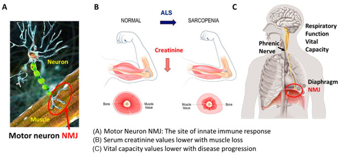 Biomed_MDPI's tweet photo. 🎯EDITOR’S PICK | A standout article selected by our editors
📌Systemic Innate Immune System Restoration as a Therapeutic Approach for Neurodegenerative Disease: Effects of NP001 on Amyotrophic Lateral Sclerosis Progression
https://t.co/4BSozvi2VQ
#EditorsChoice #RecommendedRead https://t.co/60L0bgNJcm