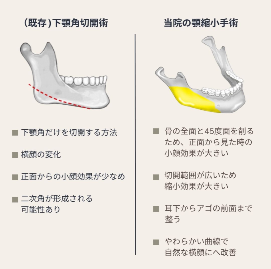 faceline1004's tweet photo. 小顔・Vラインを目指すなら「エラを切るだけ」の手術には注意。

当院では、顎ラインを一直線に切るだけではなく、骨の厚みまで薄くする手術方法を採用しています。

そのため、
・横顔だけでなく正面からも小顔効果を目指せる
・より自然なVラインを形成しやすい
・骨格に合わせたデザインが可能

一方で、従来の手術方法は
・正面からの変化が少ない場合がある
・神経の位置によっては適応にならない場合がある
・仕上がりが不自然に見える場合がある

輪郭手術は「どれだけ骨を切るか」ではなく「どうデザインするか」が重要です。

「確実に小顔になりたい」
「自然なVラインになりたい」
「再手術は避けたい」

そんな方はぜひイ・ジンス院長へご相談ください✨

無料オンラインカウンセリング受付中
お問い合わせはプロフィールの公式LINEから📩

＃エラ手術　＃輪郭手術　＃韓国整形　＃韓国美容　＃両顎手術