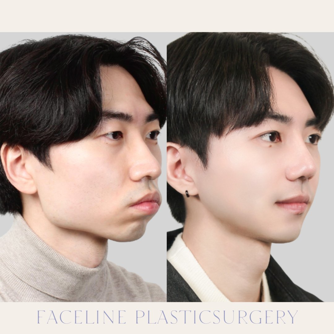 faceline1004's tweet photo. 小顔・Vラインを目指すなら「エラを切るだけ」の手術には注意。

当院では、顎ラインを一直線に切るだけではなく、骨の厚みまで薄くする手術方法を採用しています。

そのため、
・横顔だけでなく正面からも小顔効果を目指せる
・より自然なVラインを形成しやすい
・骨格に合わせたデザインが可能

一方で、従来の手術方法は
・正面からの変化が少ない場合がある
・神経の位置によっては適応にならない場合がある
・仕上がりが不自然に見える場合がある

輪郭手術は「どれだけ骨を切るか」ではなく「どうデザインするか」が重要です。

「確実に小顔になりたい」
「自然なVラインになりたい」
「再手術は避けたい」

そんな方はぜひイ・ジンス院長へご相談ください✨

無料オンラインカウンセリング受付中
お問い合わせはプロフィールの公式LINEから📩

＃エラ手術　＃輪郭手術　＃韓国整形　＃韓国美容　＃両顎手術