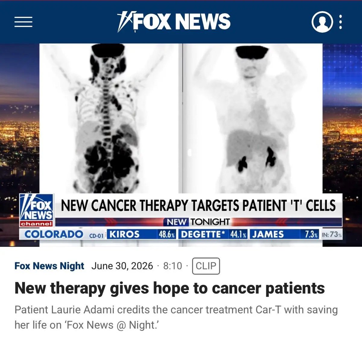 gainzalgo's tweet photo. $IBRX big mainstream attention here. Fox News highlighted CAR-T/cell therapy after a patient said it saved her life following 12 years of illness. cancer treatment is entering a very different era. https://t.co/leDVvoV5On