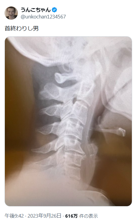 ytranking's tweet photo. 加藤純一、「超ストレートネック」3年放置で右腕にしびれ
視聴者からの頸椎ヘルニア疑う声で病院受診を決意

▼記事
https://t.co/syCg2f6uJ2

2023年、極度のストレートネックと診断され「神経症状が出ていないのが奇跡」と言われていた
↓
「怖いから」と通院をやめ3年放置
↓
右腕のしびれが2週間取れず、激痛で朝起きれないこともあると告白
↓
視聴者から頸椎ヘルニアを疑う声が続出し、病院受診を決意
「なんで俺無視してたんだろう」と後悔の念も口に