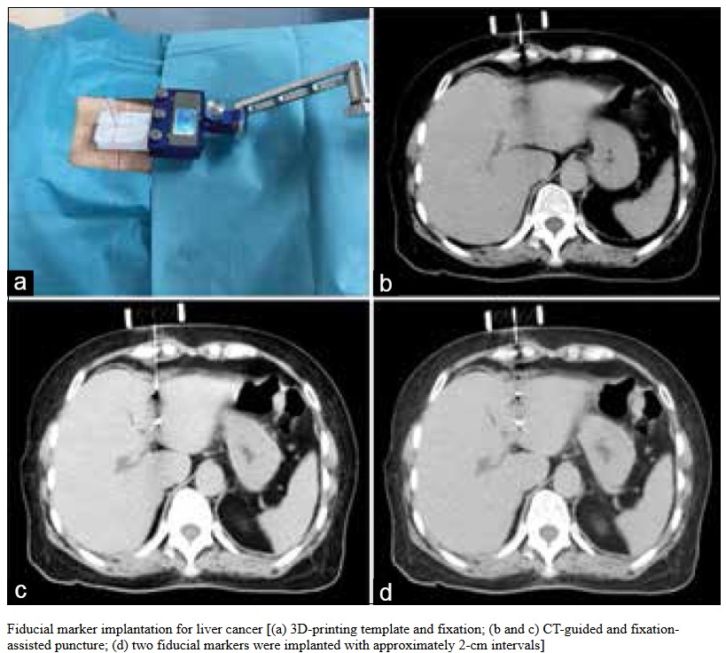Accuray_Fr's tweet photo. Le consensus d'experts chinois sur la #radiochirurgie robotisée avec le #système #CyberKnife du #carcinome hépatocellulaire vient de paraître. Pour en savoir plus : 🔗https://t.co/EvM4oqGagX
#RadOnc #radiothérapie #CancerDuFoie #CHC #RadOncNews https://t.co/cBifu69MhZ