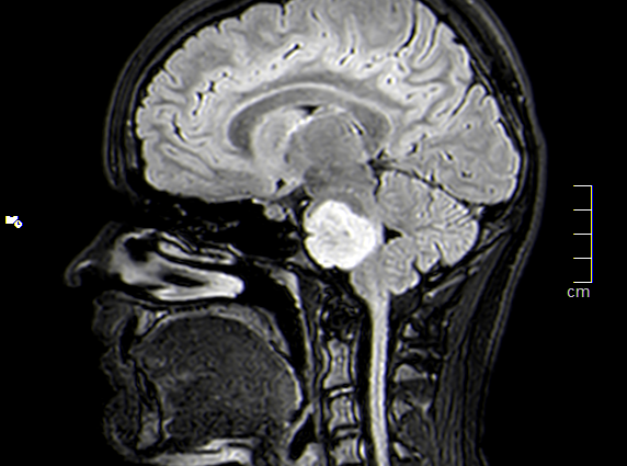 cronache_s's tweet photo. Una immunoterapia prende di mira tumori cerebrali aggressivi e il loro carburante.Sviluppata  nuova strategia di immunoterapia oncologica che può attaccare contemporaneamente tumori cerebrali mortali e le cellule immunitarie che li aiutano a crescere.
https://t.co/NXP2Bt6qff https://t.co/QVzvdNRR0K