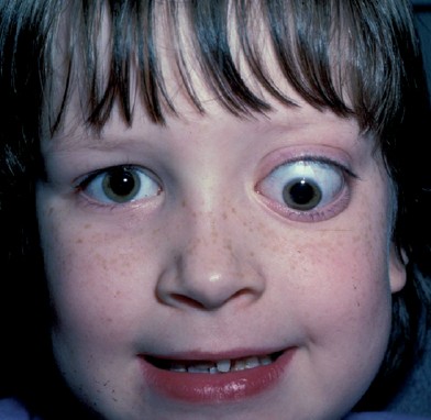 Ennan_D's tweet photo. Optic nerve glioma is most strongly associated with:

A. Marfan syndrome
B. Down syndrome
C. Neurofibromatosis type 1 (NF1)
D. Tuberous sclerosis https://t.co/xnJngZkWNK