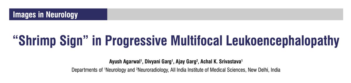 AnnIndAcadNeur's tweet photo. Shrimp sign has an 85% sensitivity, 100% specificity and 100% PPV for diagnosing PML. Asymmetry of the MCP lesions is paramount! Ajay Garg et al published one such case highlighting the "Shrimp sign" 🍤 in PML.  @neuro_ian #PML Link: 10.4103/aian.aian_932_23 https://t.co/uV1SoGLNhi