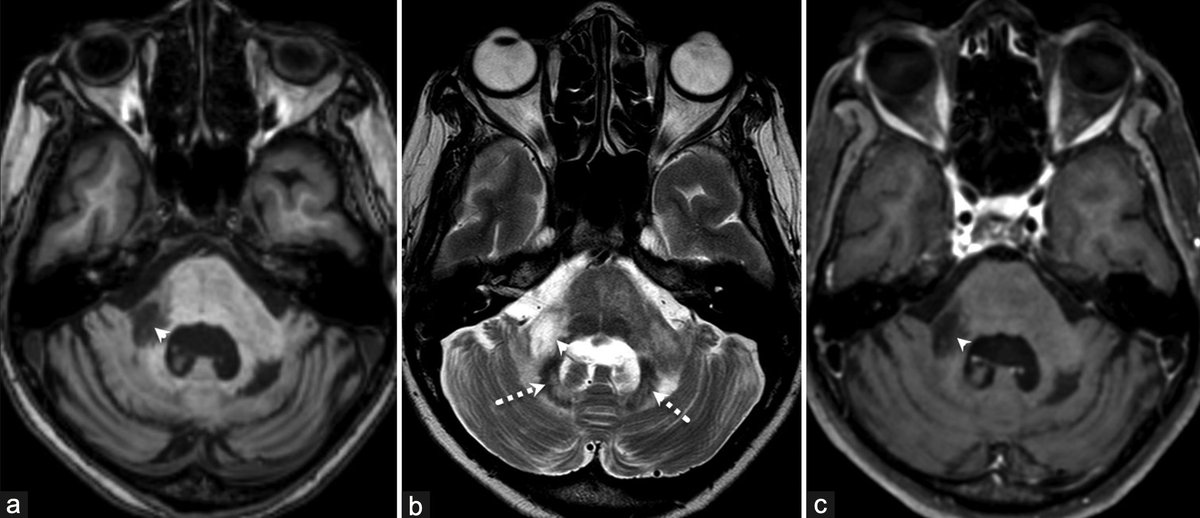 AnnIndAcadNeur's tweet photo. Shrimp sign has an 85% sensitivity, 100% specificity and 100% PPV for diagnosing PML. Asymmetry of the MCP lesions is paramount! Ajay Garg et al published one such case highlighting the "Shrimp sign" 🍤 in PML.  @neuro_ian #PML Link: 10.4103/aian.aian_932_23 https://t.co/uV1SoGLNhi
