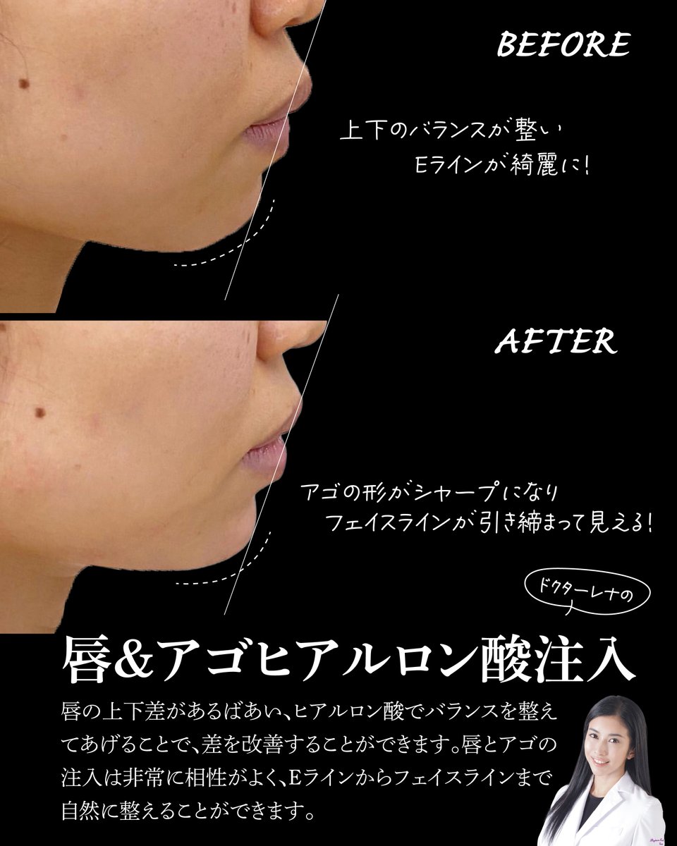 Rejuva3's tweet photo. 上下の唇のバランスを整える
≪ヒアルロン酸注入≫

受け口だったり、逆に上唇が突出して見える場合は、唇にヒアルロン酸を注入することで、バランスを整えることができます
併せてアゴの形も整えるとよりEラインが綺麗になります

ご予約は
LINE@rejuva
https://t.co/CAmIyUYJYe
#Eライン https://t.co/XATpqNeToO