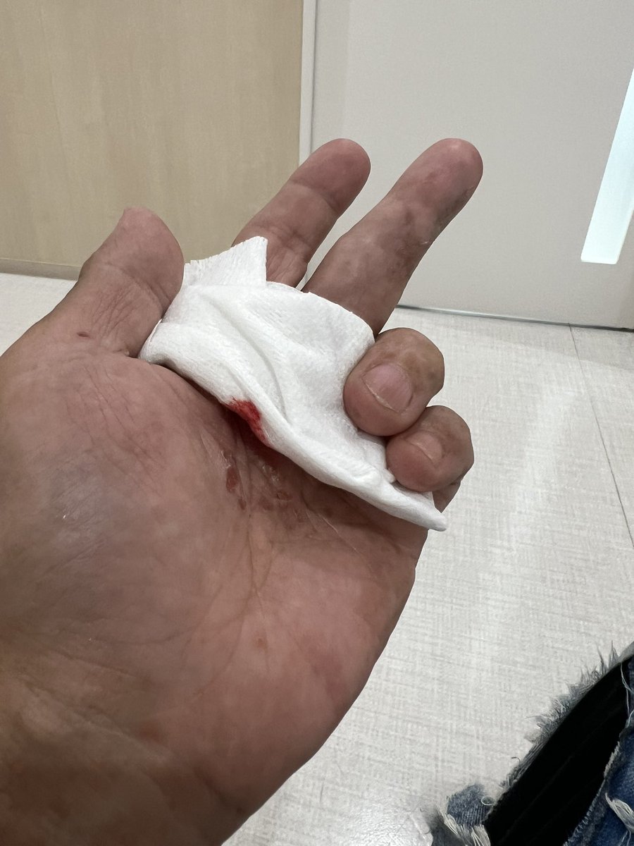 BeFree_office's tweet photo. 火曜から腫れて痛くなって
水曜に急遽病院
そして今日
またまた緊急に麻酔3箇所打って
切って消毒＆腱をズラし４針縫った…
コレ…
明日から仕事出来るのか…？
ん〜やるしかないでしょ！ https://t.co/AfHqlg7jVz