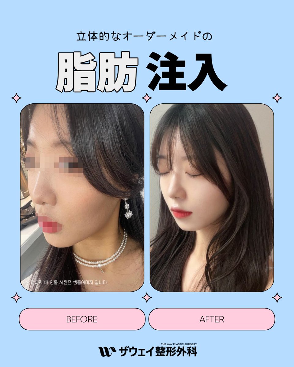 thewayps's tweet photo. 足している部分は自然に補いながら
立体的で調和の取れたフェイスラインへ🍒

前後写真でも変化を確認できる
自然な仕上がりが特徴です📸

NAVERで「顔の脂肪移植」と検索すると
当院は人気クリニックTOP3に選ばれています🔍

▶LINEで相談OK👉https://t.co/CU8AcjU2X4

#韓国脂肪注入 #顔脂肪注入 https://t.co/f3mA46QNUy