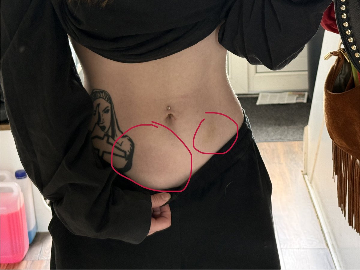 oxycosam's tweet photo. the bruises left a mark somehow - still there and it's almost been a month, what the hell https://t.co/LwObnoqu6y