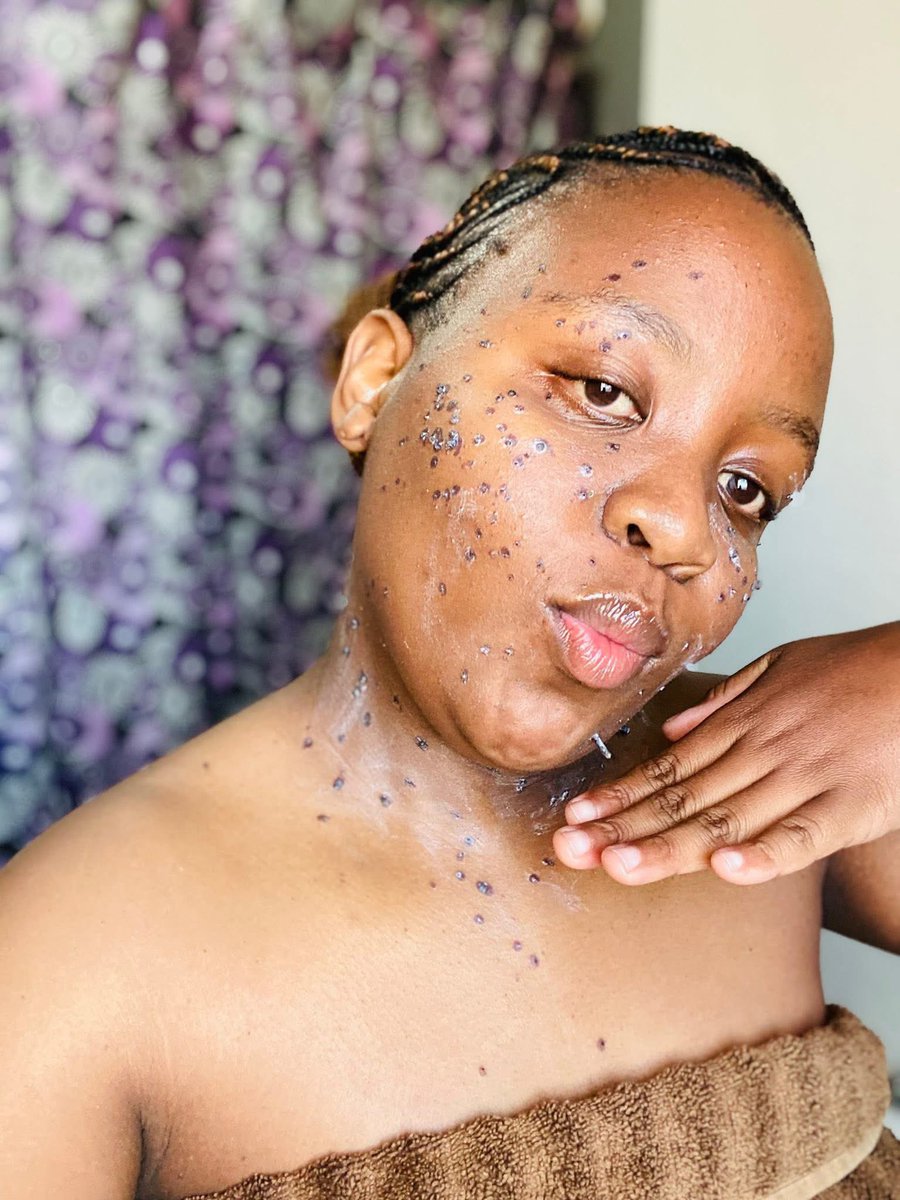 Kgadi_yaMoloto's tweet photo. What she used to remove her skin tags🤌😥 https://t.co/V1fI5AxbzP