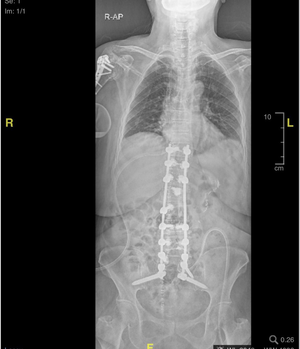 AbdullahTEissa's tweet photo. It isn’t about creating the perfect X-ray. It’s about identifying every pain generator, decompressing the neural elements, restoring age-appropriate alignment, achieving durable fixation, and respecting the patient’s biology.
Don’t fight the spine.
#SpineSurgery #ASD #Spine https://t.co/sB9weIkAWI
