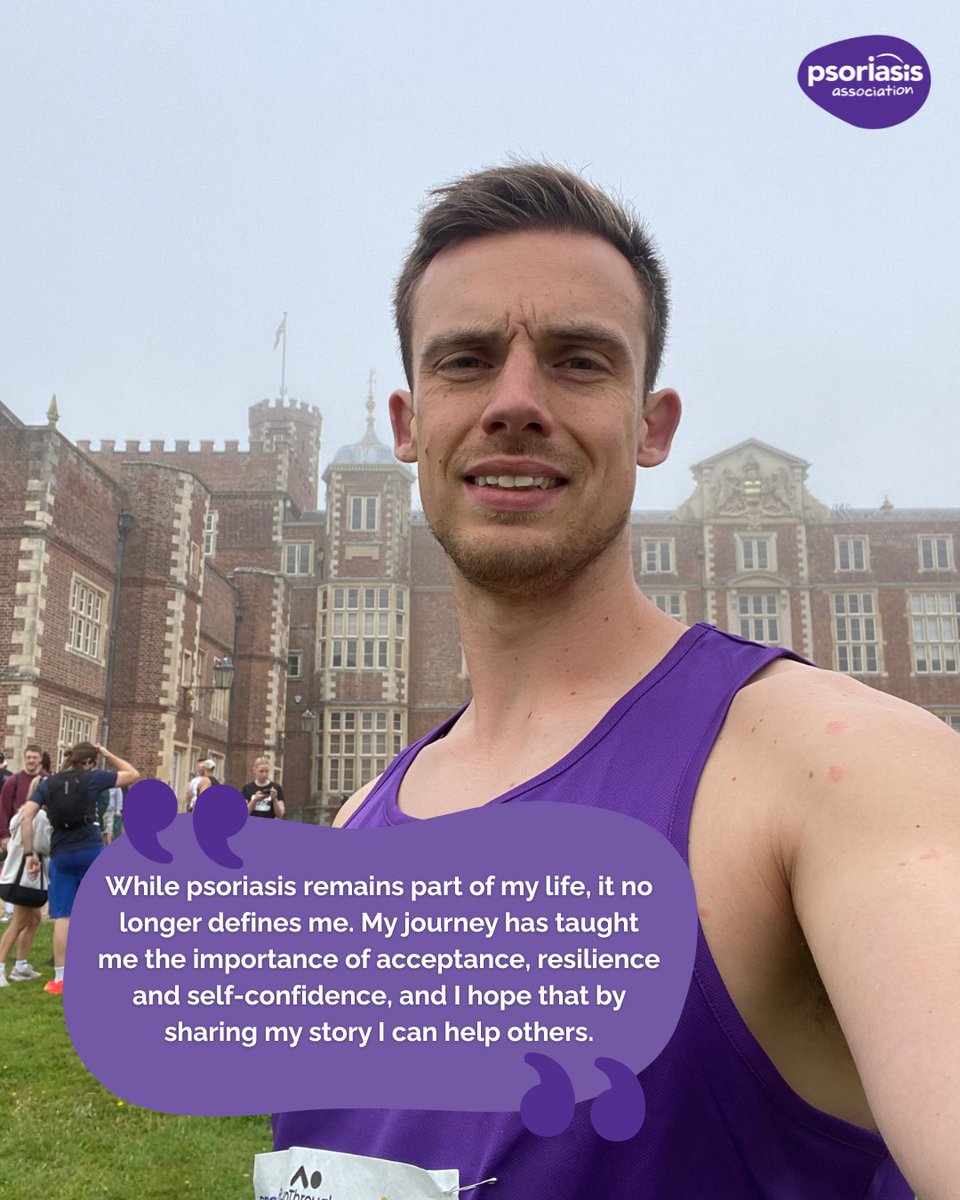 PsoriasisUK's tweet photo. A huge thank you to Craig, who recently completed the East Yorkshire Half Marathon and a 10K just one week later to support the Psoriasis Association. 💜

Having lived with psoriasis for around nine years, Craig used the challenge to raise awareness and share his experience of learning to accept the condition and not let it define him.

His efforts have raised nearly £500 for the Psoriasis Association!

Thank you, Craig, for sharing your story and supporting others affected by psoriasis. 👏