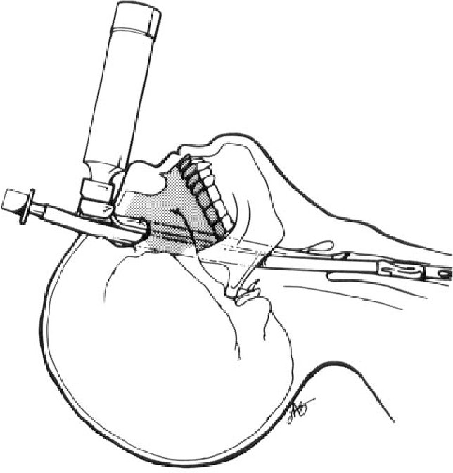 nervemed's tweet photo. Not every airway follows the usual path. 

A rare case where the TRANSORBITAL route was used to secure the airway. https://t.co/T4flBQqR2G