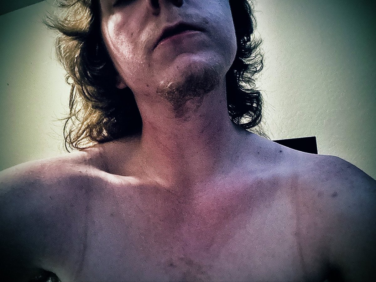 rexi4LyfeAlexxx's tweet photo. #collarbone #check today…. Feels good to be outta ‘da looney bin’ especially after being sent for a severe #autistic #meltdown L O L ….. no clue what my weight is now, but I think I still was able to lose weight in the ward if not just maintaining …. Ugh. #maleed #edrtwt #aan https://t.co/kFvE2PnmQ6