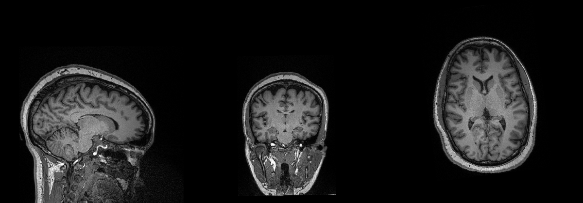 CarrieJohnson_E's tweet photo. A new way, I am dealing with stupid people. Here my brain &amp; stomach images from a MGH clinical research study. Clinical Research Title: Modulation of Gastric Sensitivity and Accommodation by Vagal Nerve Stimulation, Mass General Hospital -Principal Investigator: Braden Kuo, MD. https://t.co/ChetAV4Ywy