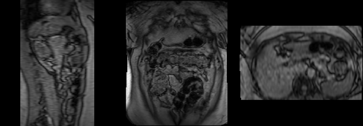 CarrieJohnson_E's tweet photo. A new way, I am dealing with stupid people. Here my brain &amp; stomach images from a MGH clinical research study. Clinical Research Title: Modulation of Gastric Sensitivity and Accommodation by Vagal Nerve Stimulation, Mass General Hospital -Principal Investigator: Braden Kuo, MD. https://t.co/ChetAV4Ywy