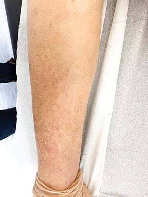 Applied_RadOnc's tweet photo. Case Report: Abscopal effect of radiation therapy in monotherapy in a patient with malignant melanoma

Case details 🔗 https://t.co/y4YzQnQBWe

#RadOnc #RadiationOncology #CancerCare #CaseStudy #RadOncEd #MedEd #Melanoma https://t.co/Td97eyBOCo