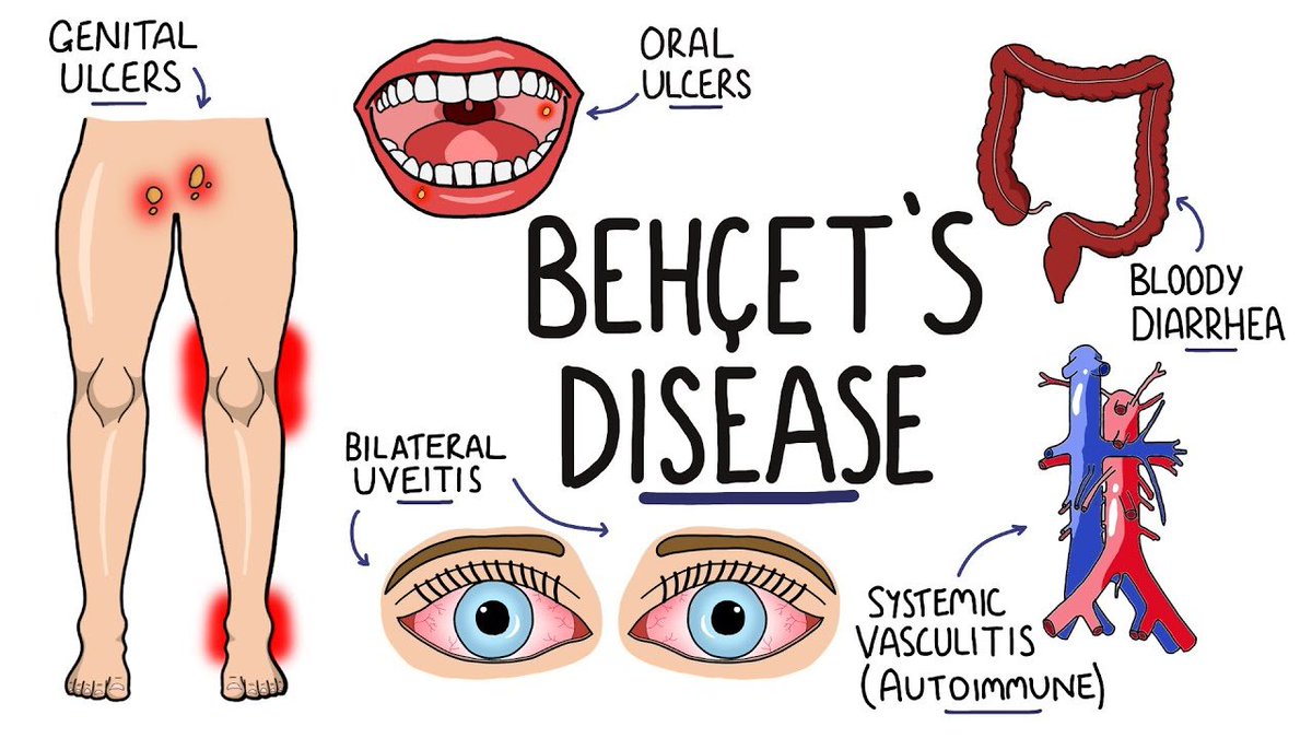 Chiragrx07's tweet photo. Behçet Disease - a rare, chronic, relapsing systemic vasculitis of unknown etiology, associated with HLA-B51.

Key features:-

Recurrent oral aphthous ulcers (hallmark, almost always present)
Genital ulcers
Uveitis (can cause blindness) / other ocular involvement
Skin lesions: erythema nodosum, pseudofolliculitis, pathergy reaction (papule/pustule at needle prick site - used diagnostically)
Vascular involvement: both arterial and venous thrombosis (unusual among vasculitides)
Can involve GI, CNS, and joints.

Diagnosis:

 Clinical (International Study Group criteria) - recurrent oral ulceration + 2 of (genital ulcers, eye lesions, skin lesions, positive pathergy test).

Treatment: Colchicine (mucocutaneous), corticosteroids, azathioprine/immunosuppressants for severe organ involvement, biologics (anti-TNF) in refractory cases.