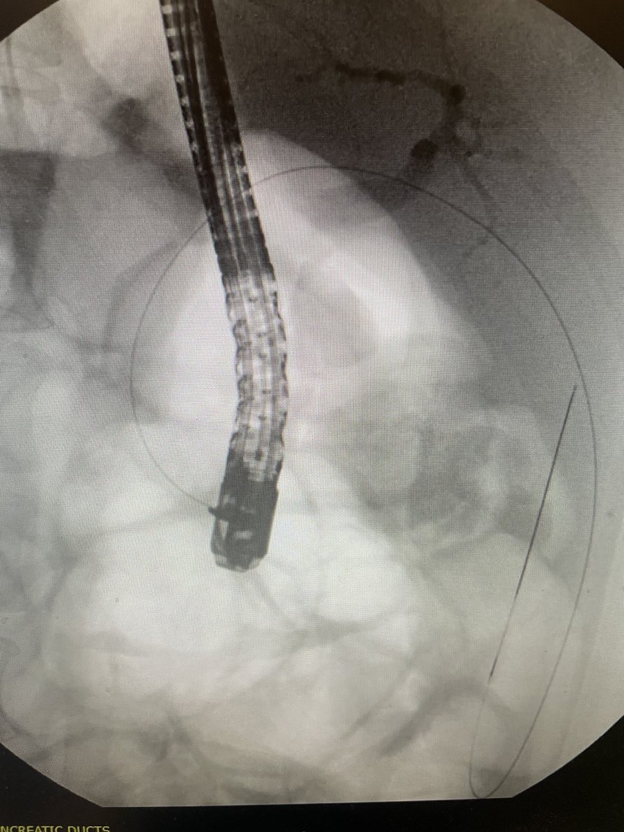 DouglasAdlerMD's tweet photo. So. Many. Gallbladders. Young patient who is a surgical candidate but not sure if they want surgery. Cholecystitis. Transcystic stent placed to buy them time to think. #gitwitter #surgery https://t.co/XCvfkycOFn