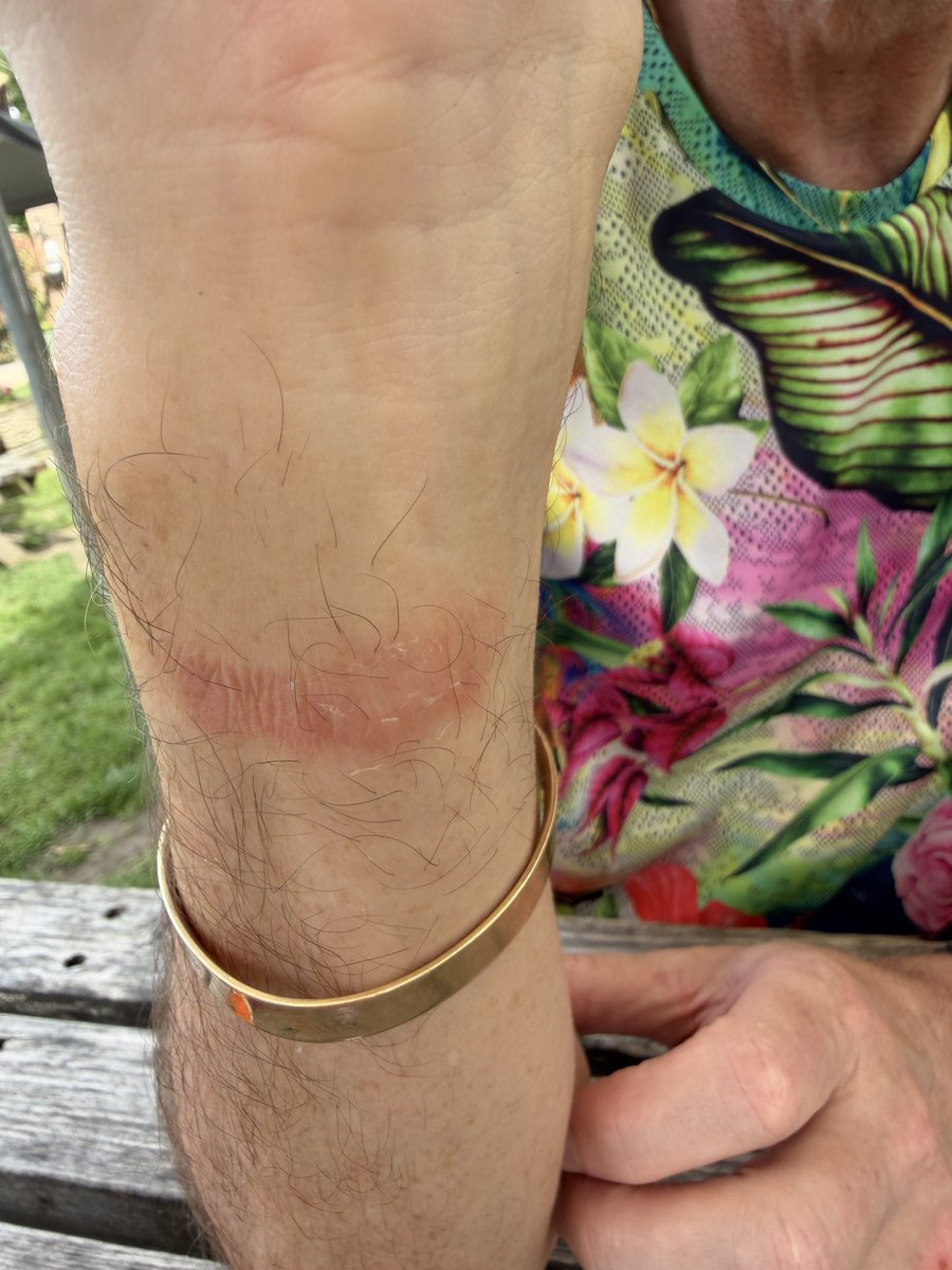 steventhorpe63's tweet photo. @hilo_health I purchased a HiLo BP mon several weeks ago but suffered an allergic reaction to the standard strap. See photos Despite several cleaning attempts I get the same reaction after wearing the strap again. 
I have looked online for an alternative strap but none available https://t.co/usb9gsOeLp